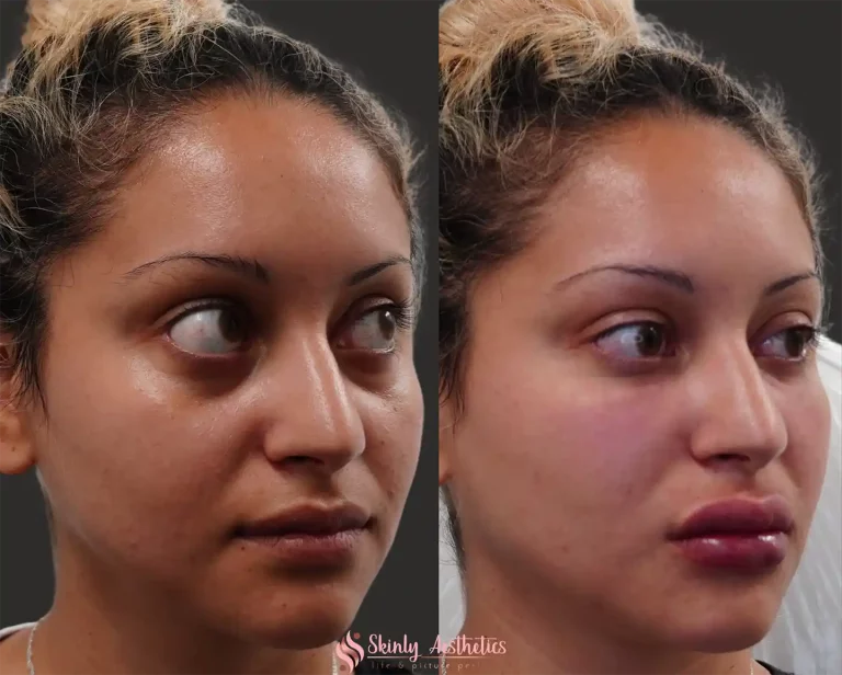 Liquid Facelift at a 45-degree angle clearly showing lifted cheeks, improved jawline definition, and softened nasolabial folds