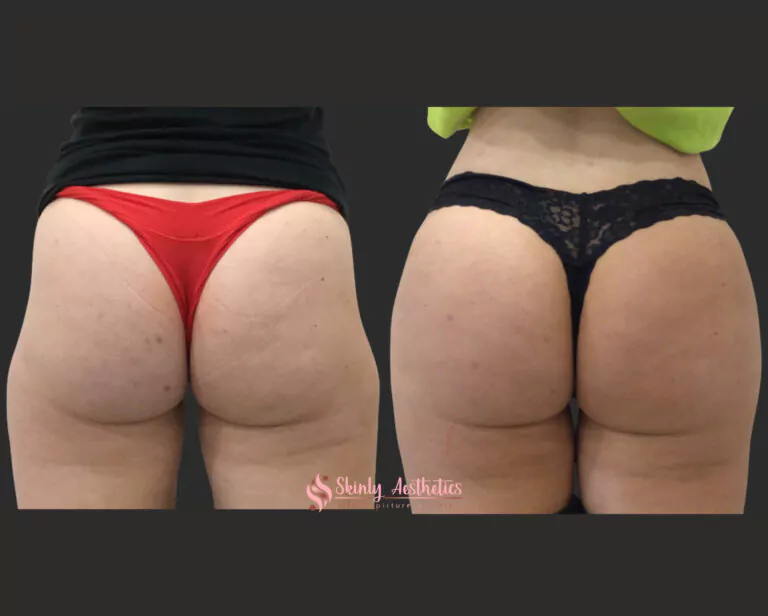 sculptra bbl