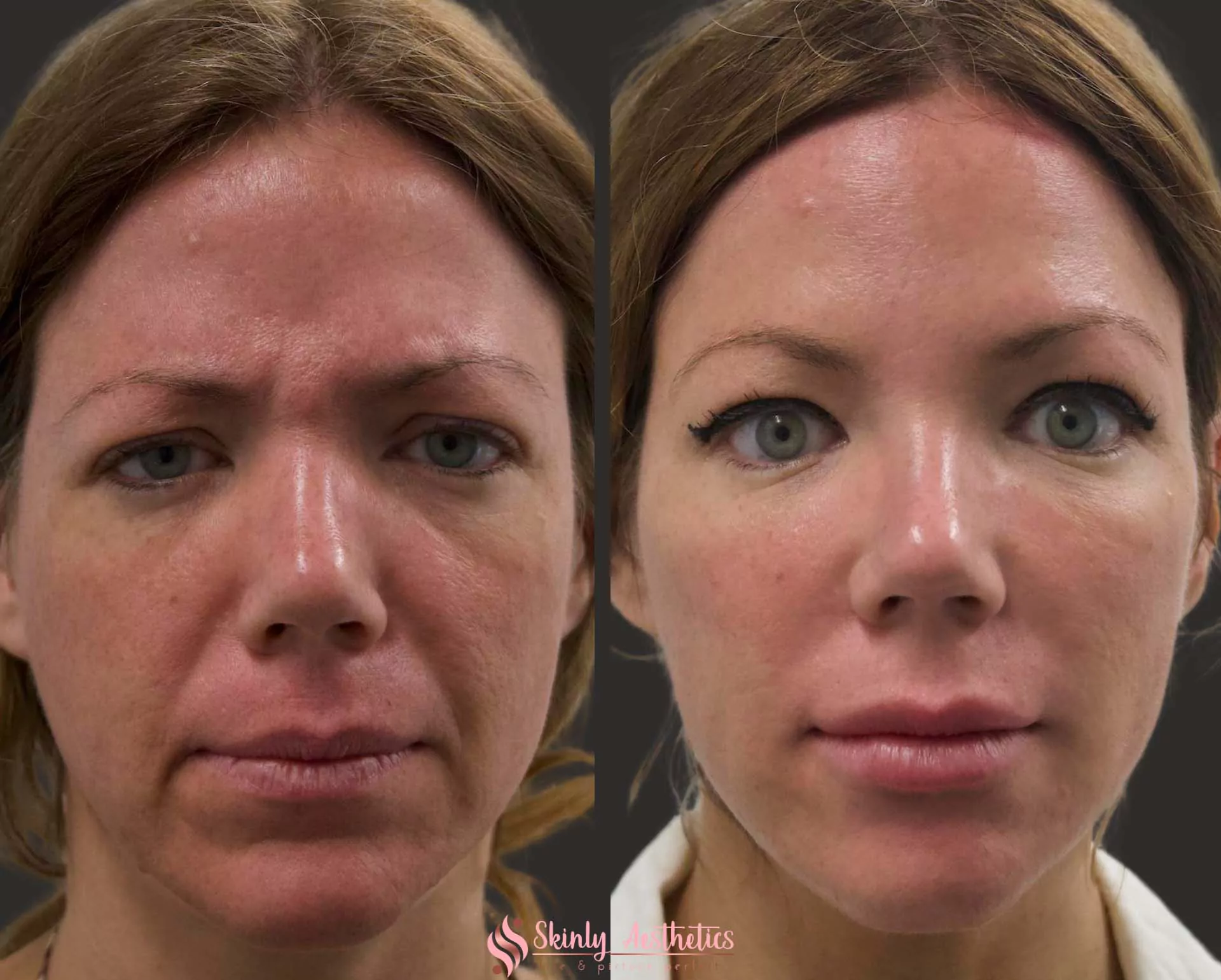 cheek filler augmentation with juvederm voluma