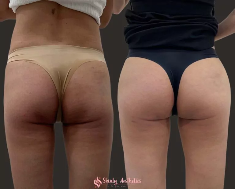 Sculptra filler hip dips treatment for hip dents