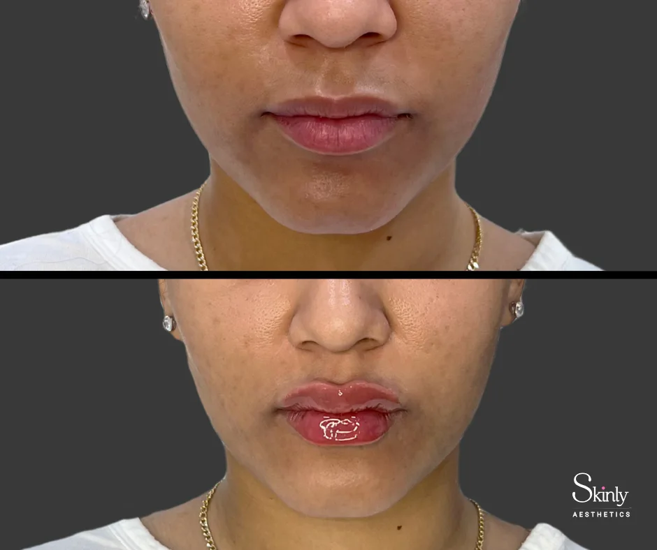 Before and after lip filler showing natural results.