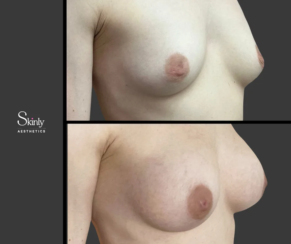 Before and after liquid breast augmentation, showing improved projection.