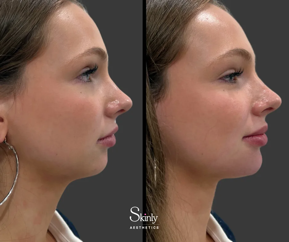 Chin filler before and after improving projection and facial balance