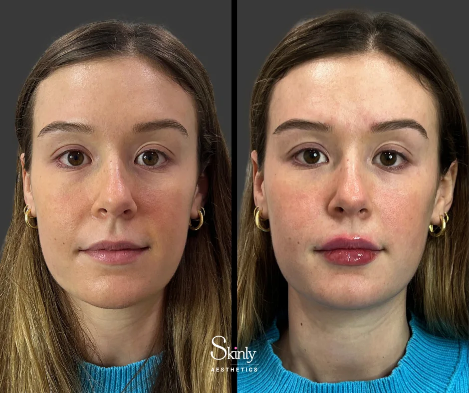 Before and after Russian lip filler results, showing subtle fullness.
