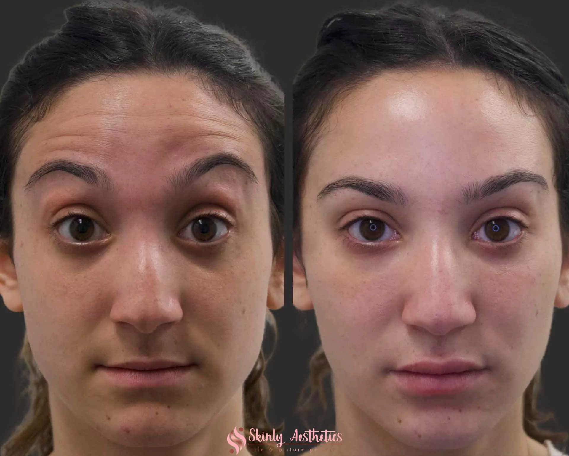 Botox forehead wrinkles