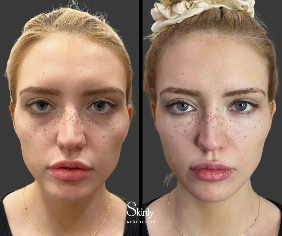 Before and after results following cheek augmentation with dermal fillers