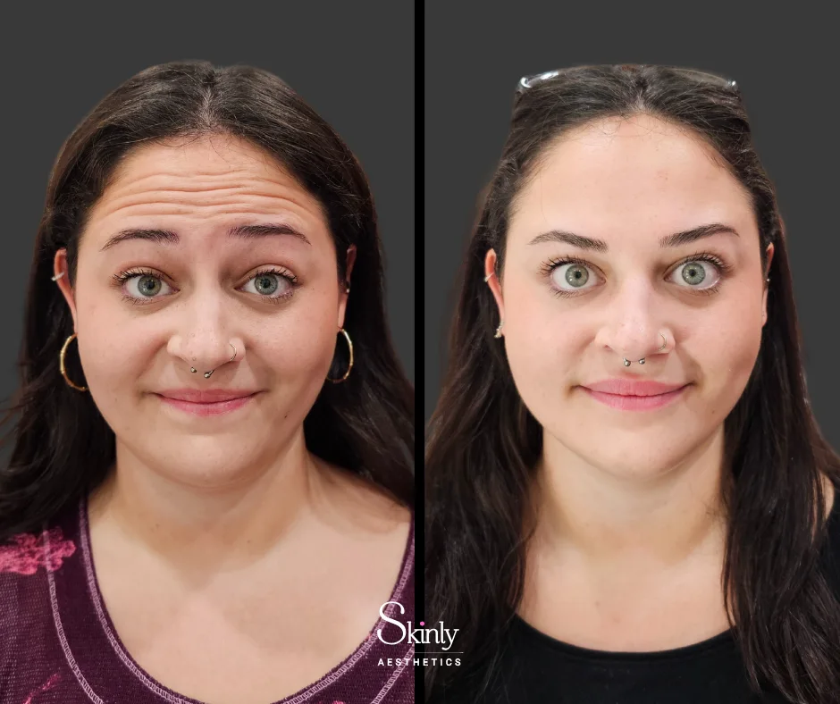 Before and after Botox for softening horizontal forehead lines in NYC.
