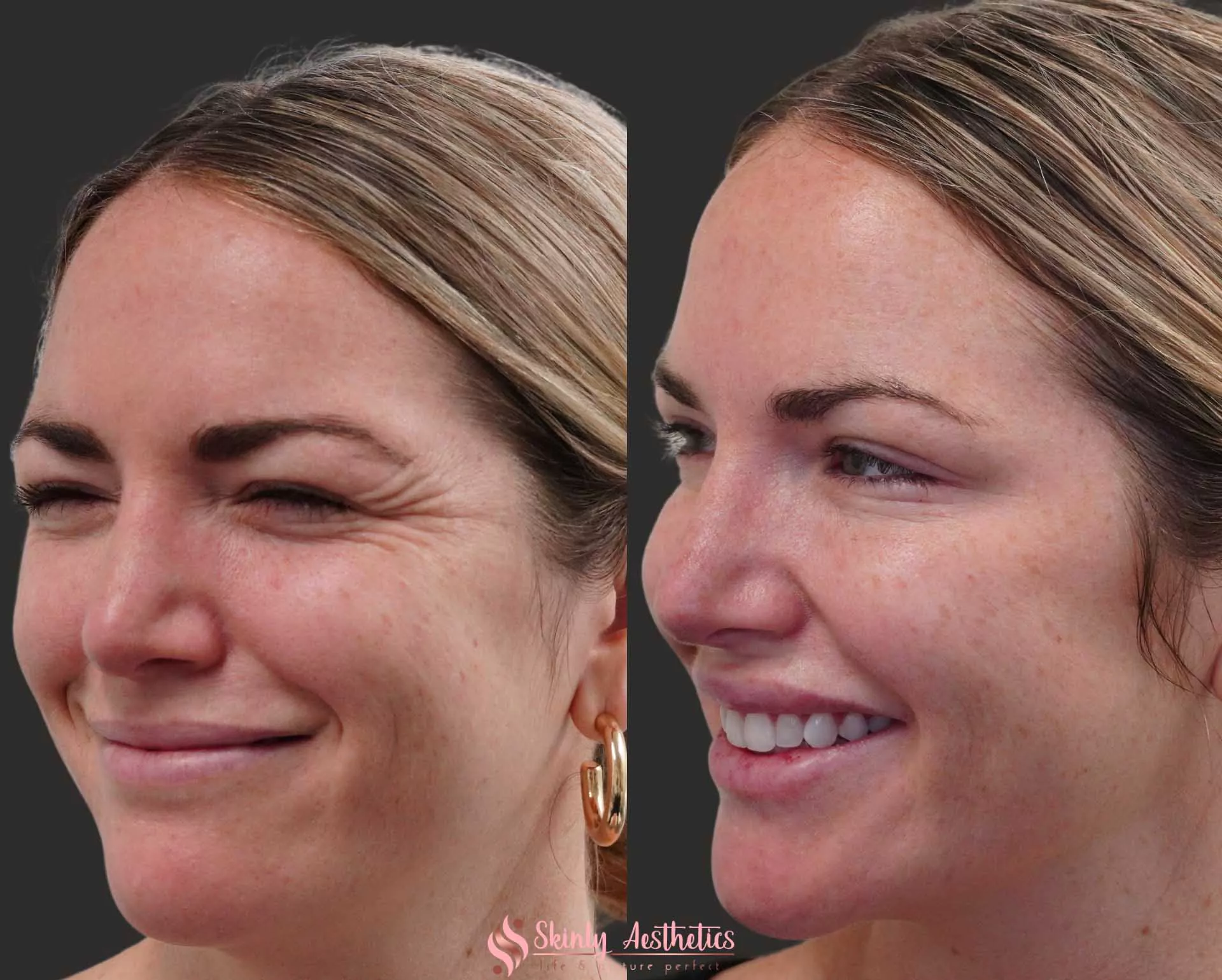 crows feet botox injection