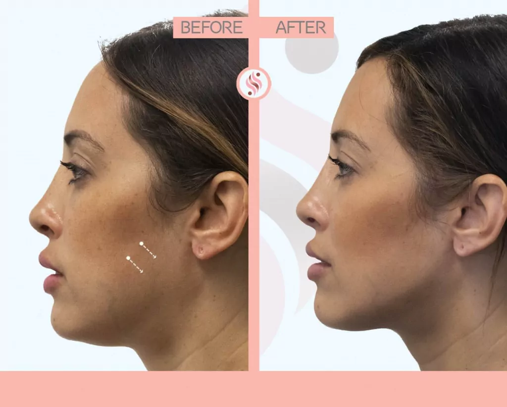 restylane injection before after