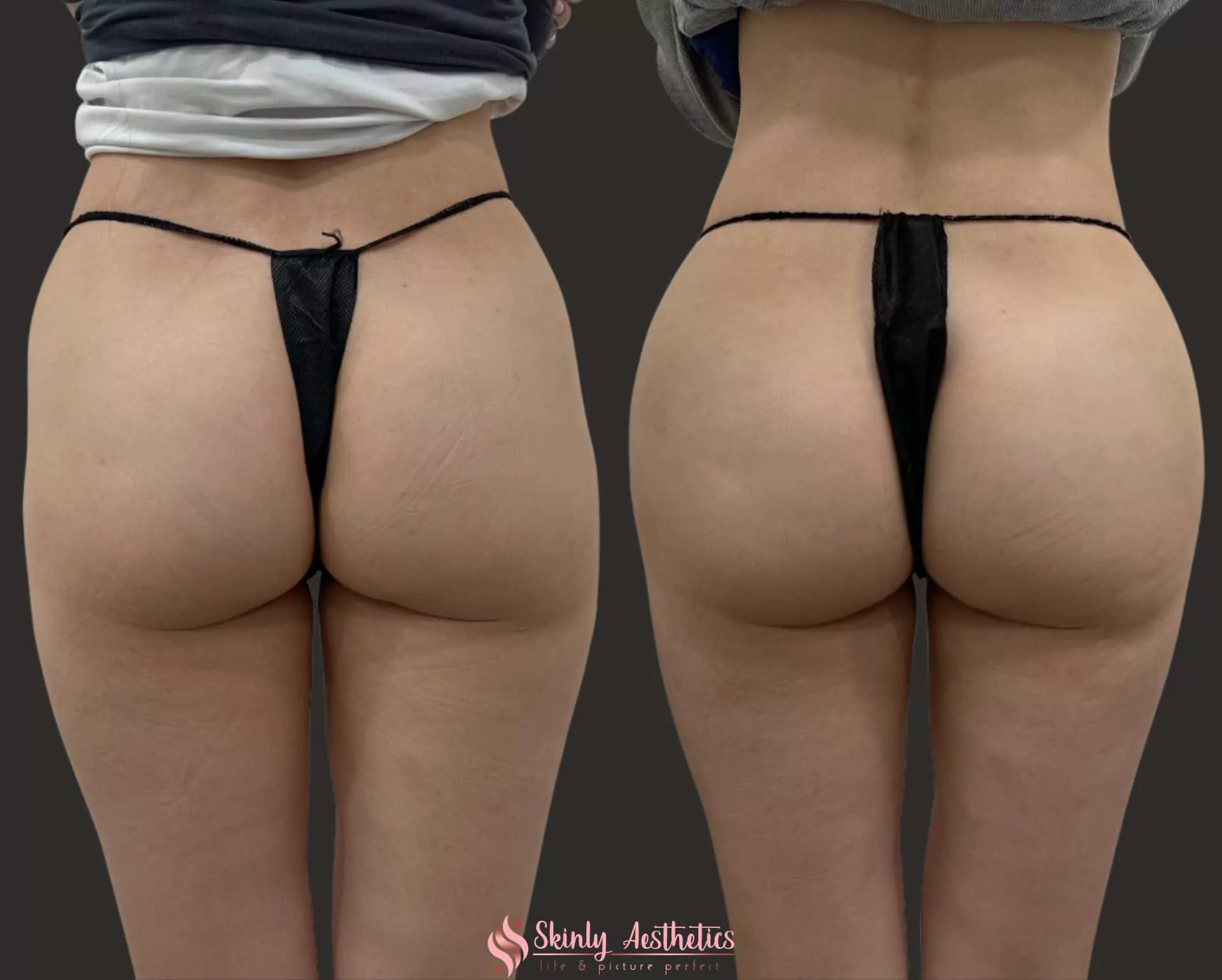 Sculptra bubble butt injections