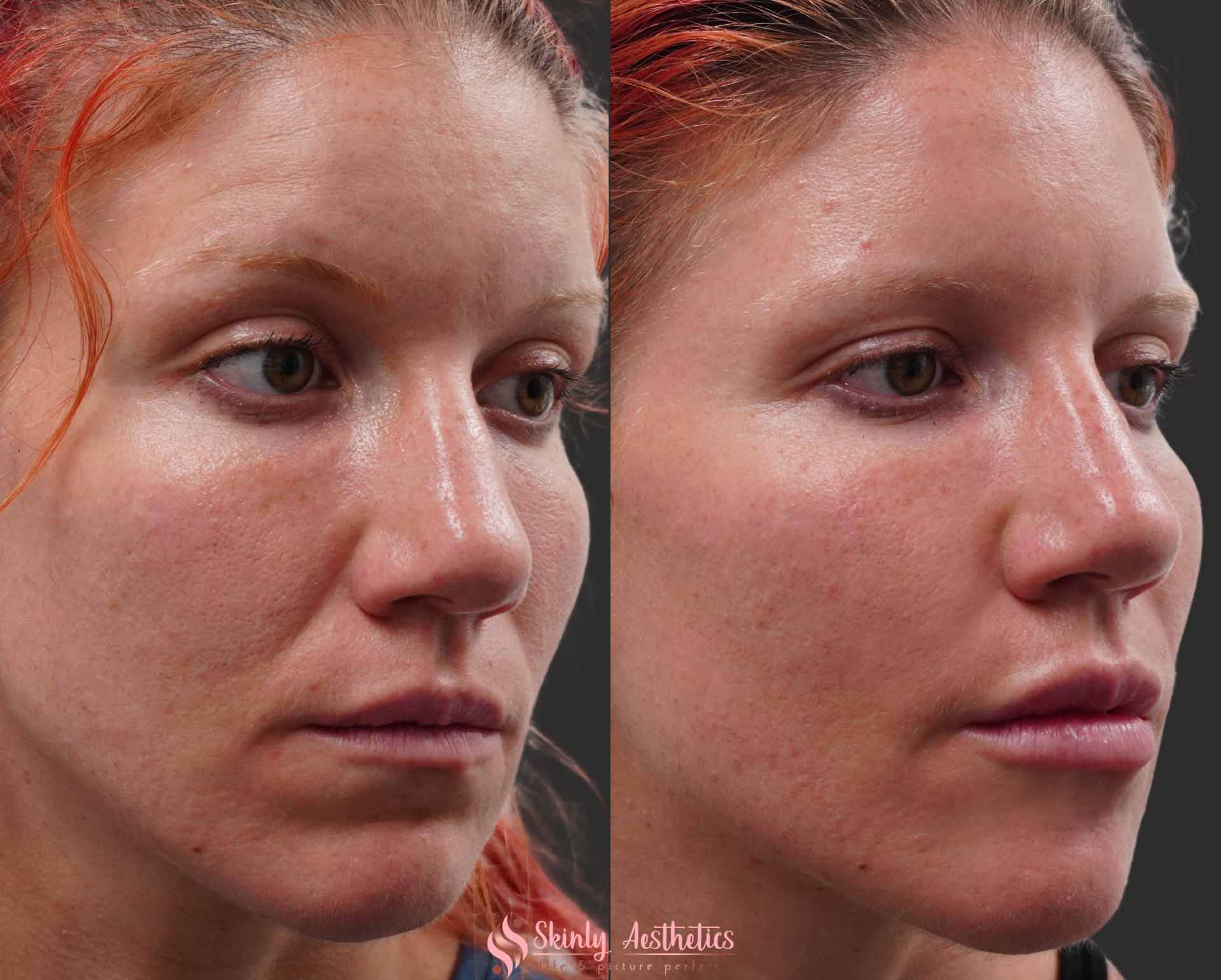 nasolabial fold and smile lines injection with Restylane