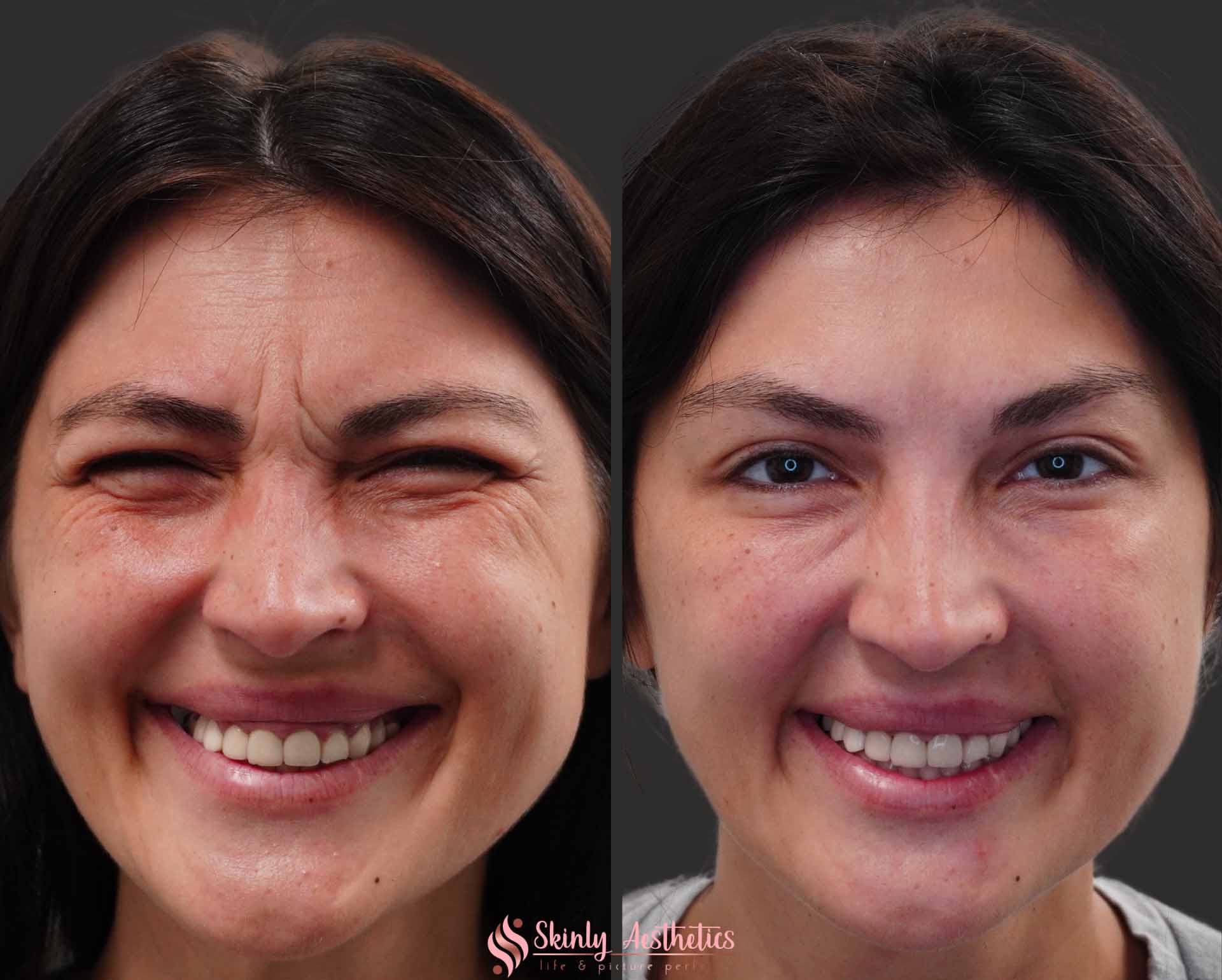botox crows feet