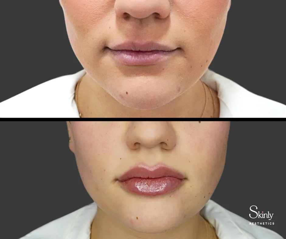 Before and after lip filler showing plump lips.