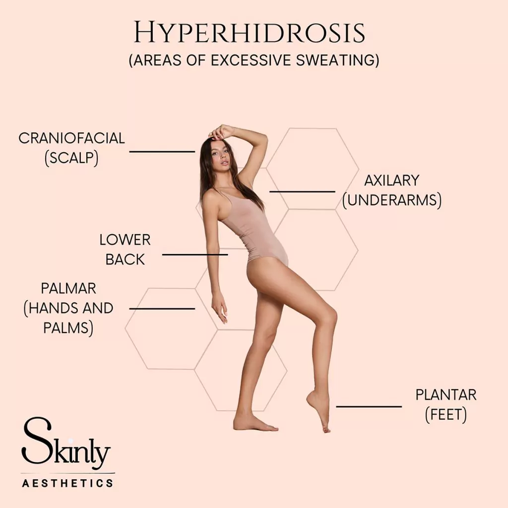 Common areas for Botox hyperhidrosis injections