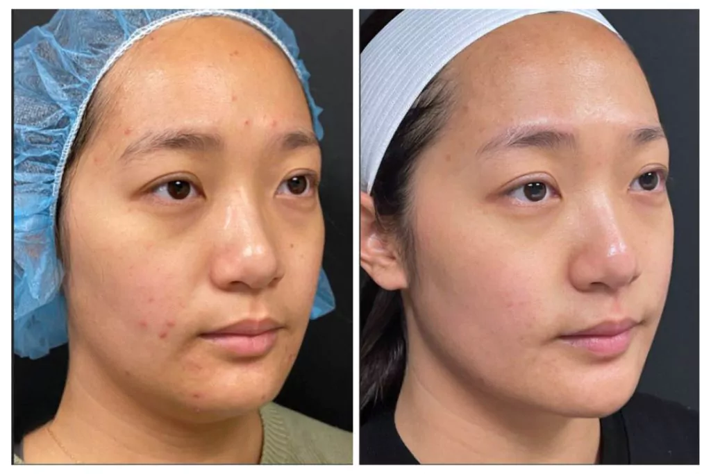 Before and after Morpheus8 RF Microneedling for acne scar reduction