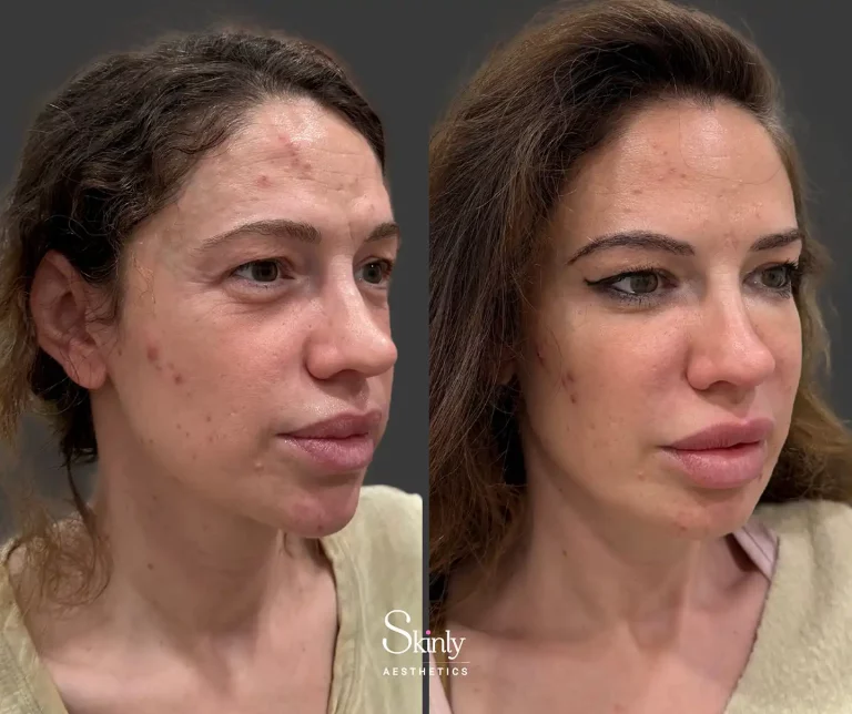 Side view showing lifted and defined cheek contours after liquid facelift