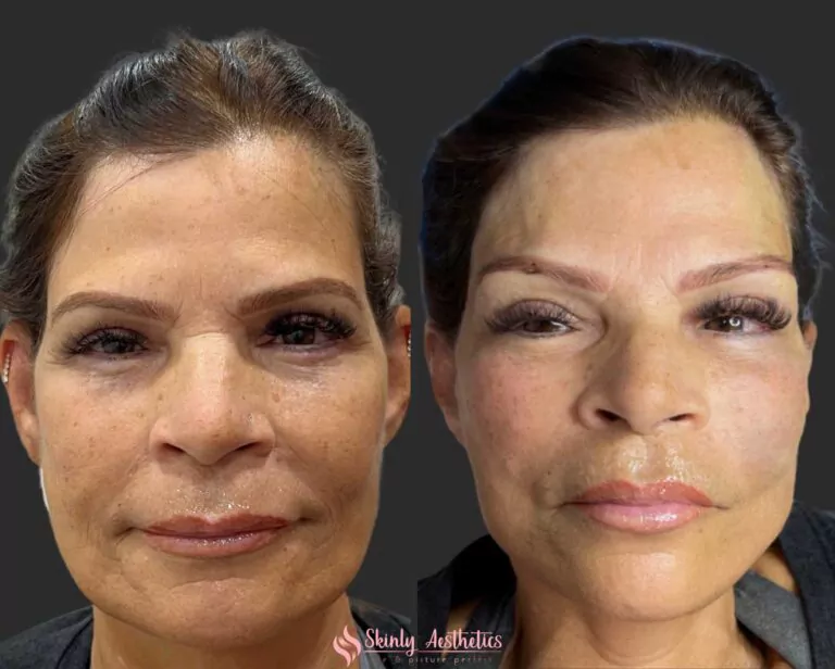 PDO face thread lift procedure