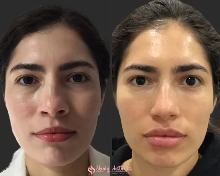 Russian lip filler augmentation technique