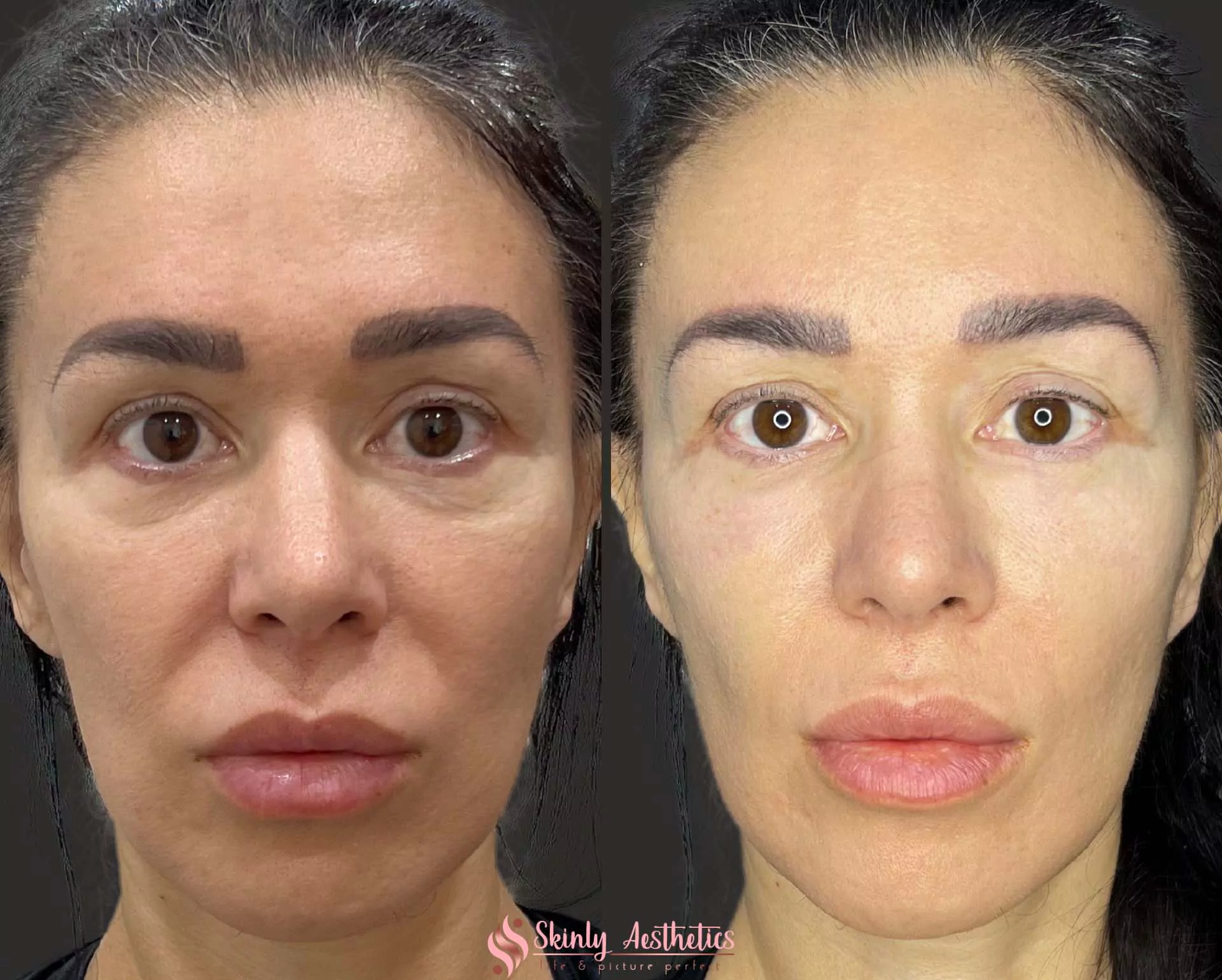 treatment of hollow tear trough region with RHA filler