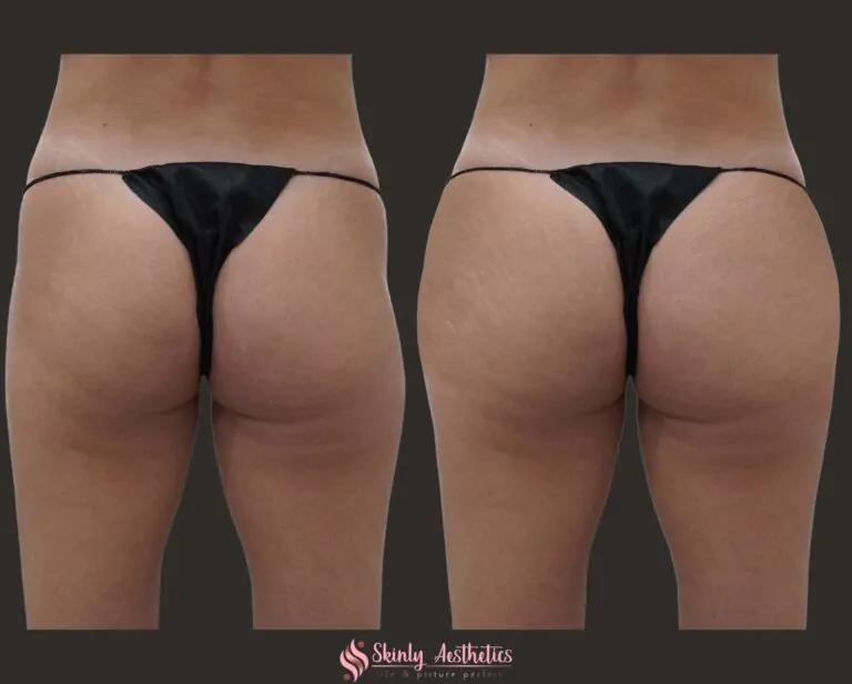 hip dip fillers