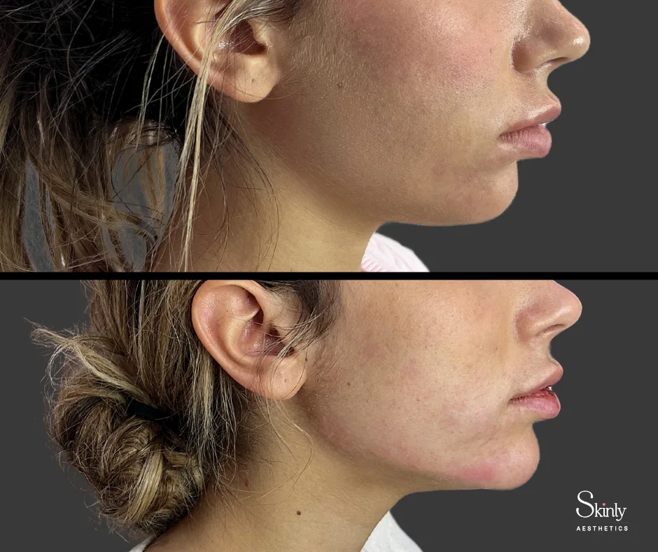 Before and after jawline filler for enhanced facial contour.