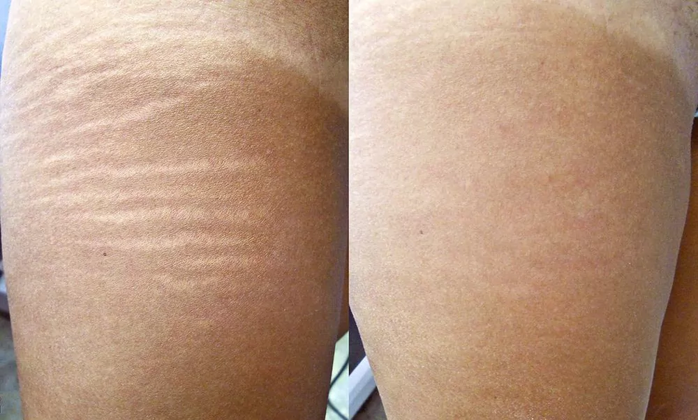 before and after results of treating stretch marks with radiofrequency microneedling
