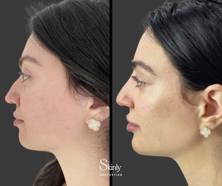 Before and after chin filler for enhanced chin projection.