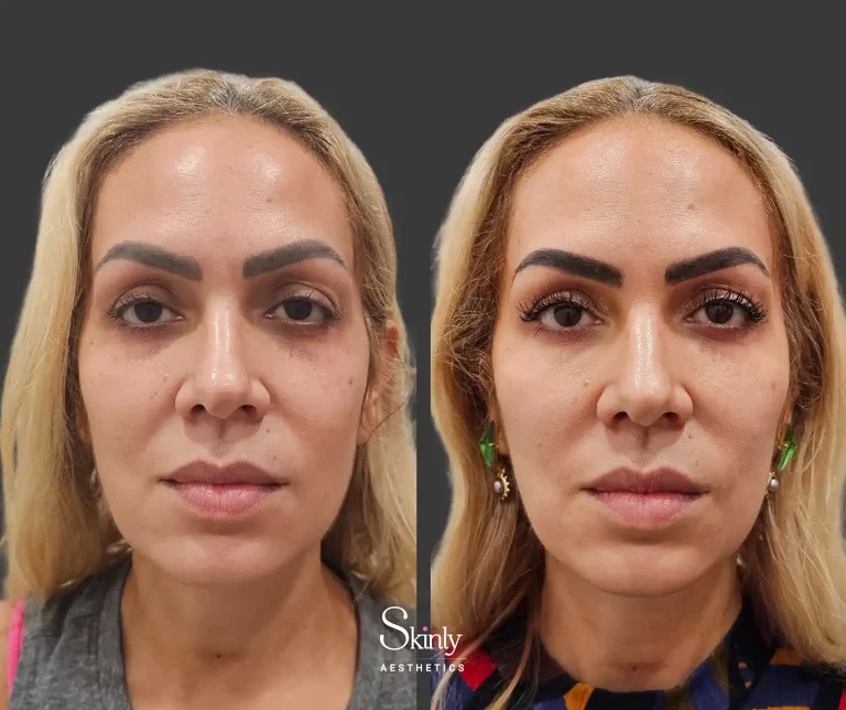 Liquid Facelift before and after photo showing restored under-eye and midface volume.