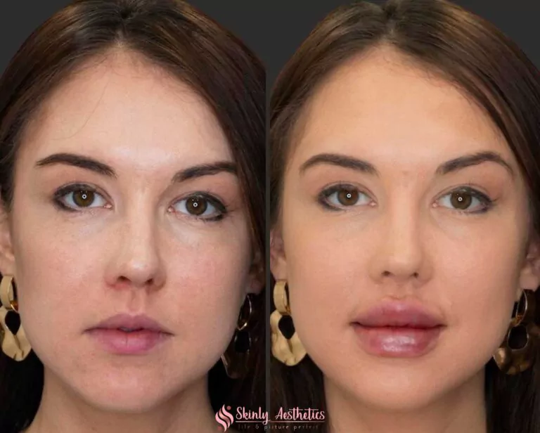 russian lip filler injection technique juvederm ultra
