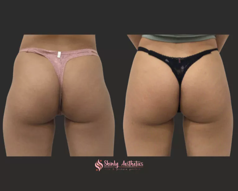 Sculptra liquid butt lift