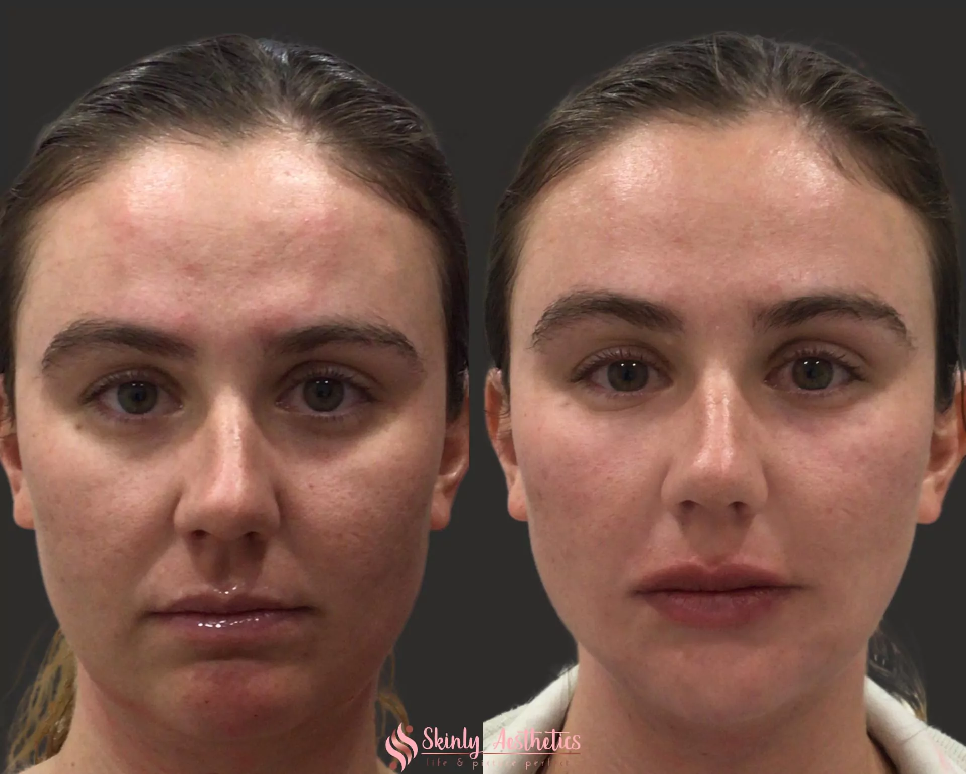 juvederm ultra lip filler enhancement