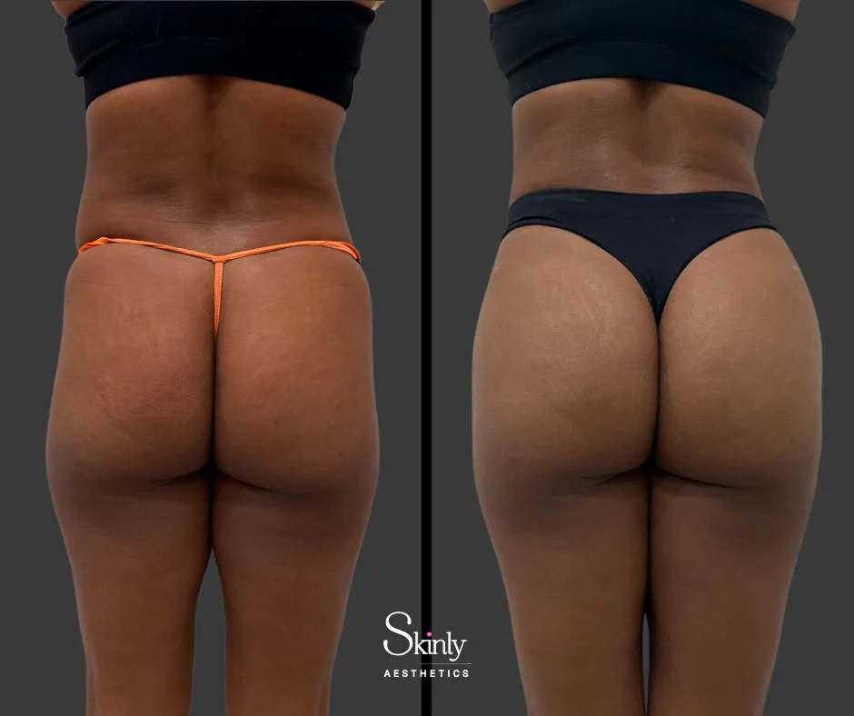 Before and after liquid butt lift for improved projection.