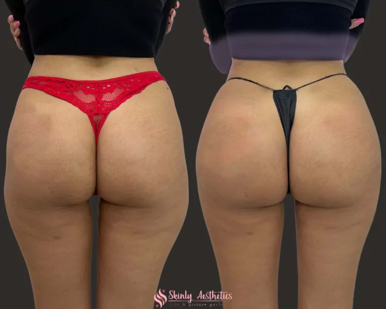sculptra butt