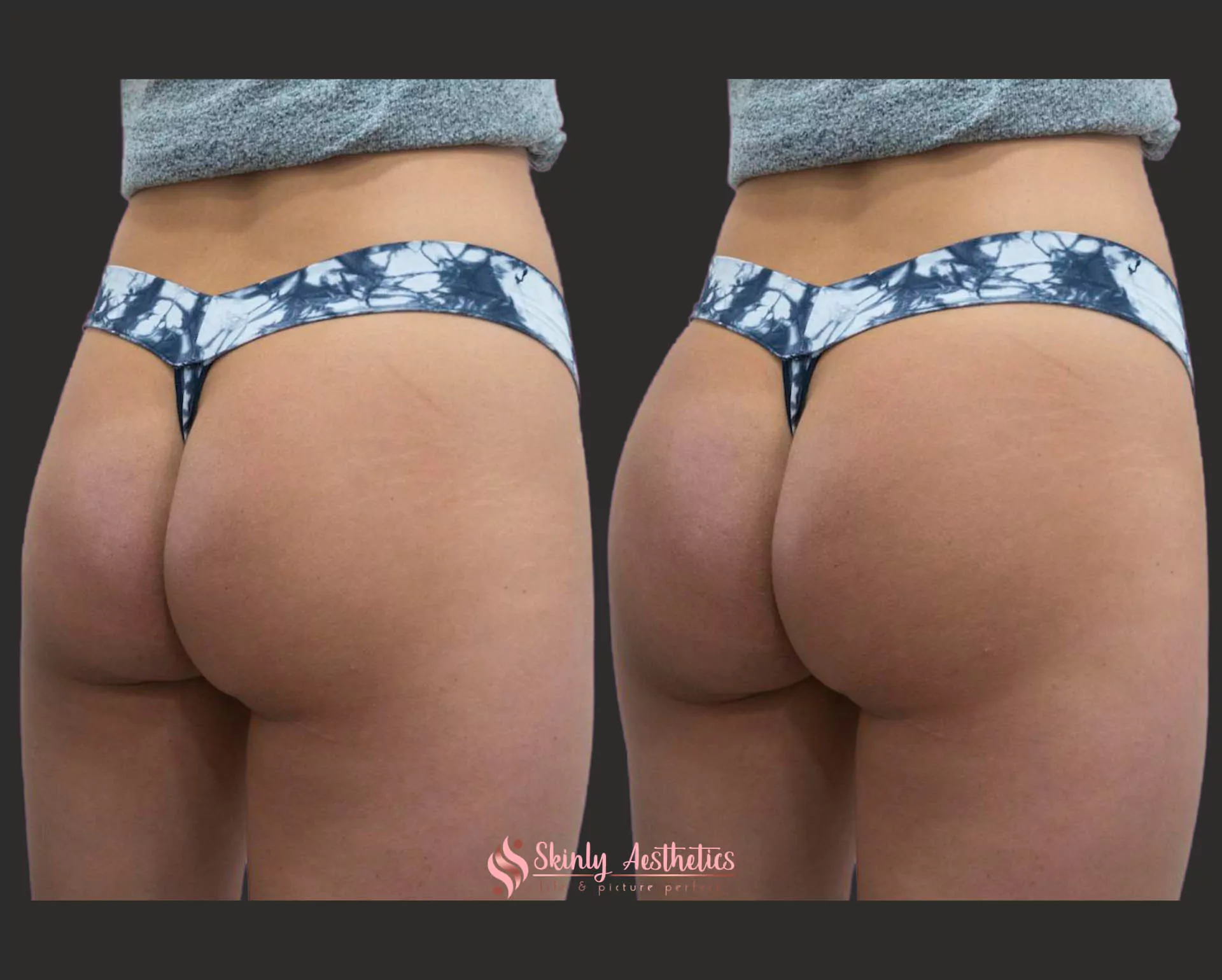 sculptra before and after