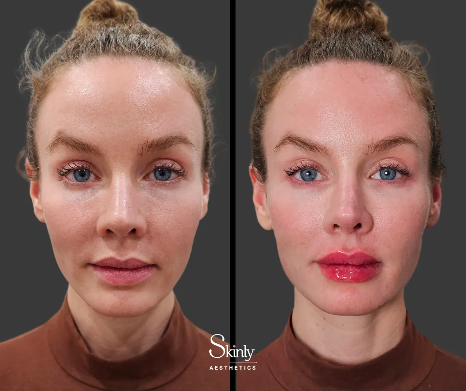 Before and after lip filler showing added fullness.
