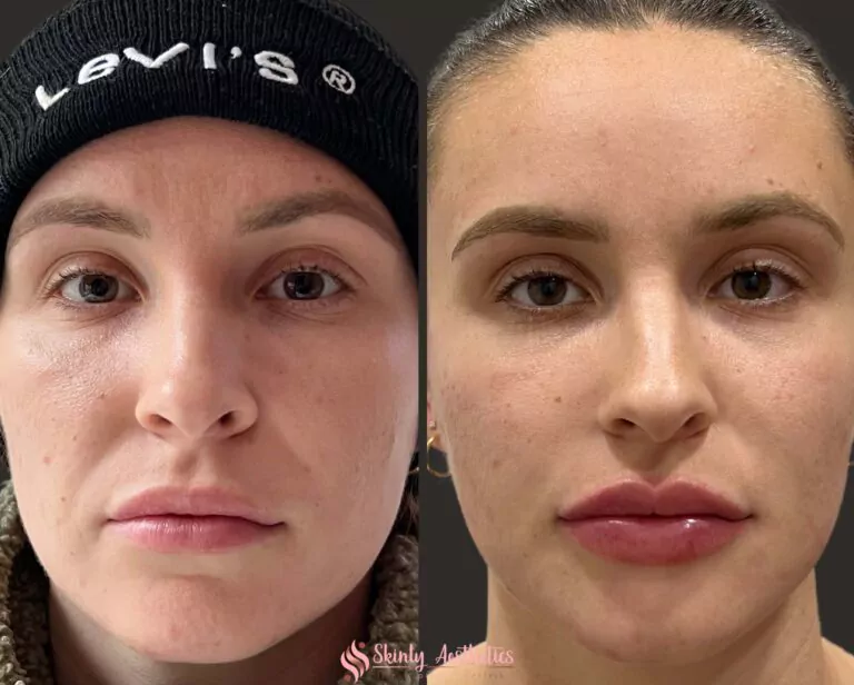 lip augmentation juvederm ultra