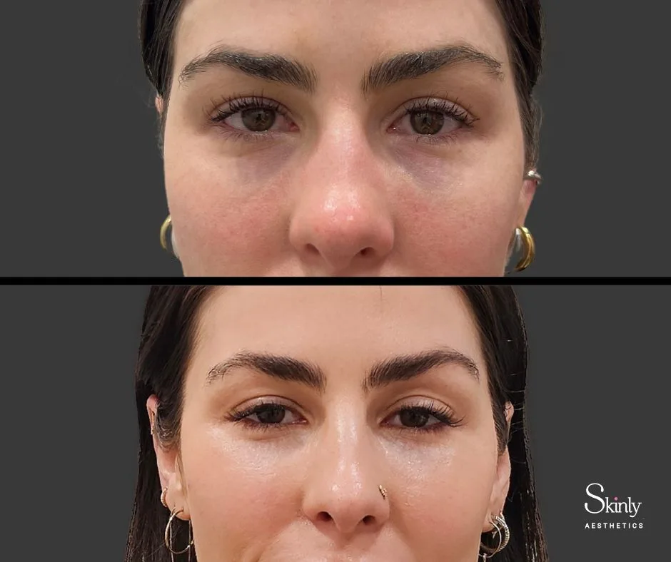 Before and after tear trough correction with dermal filler.