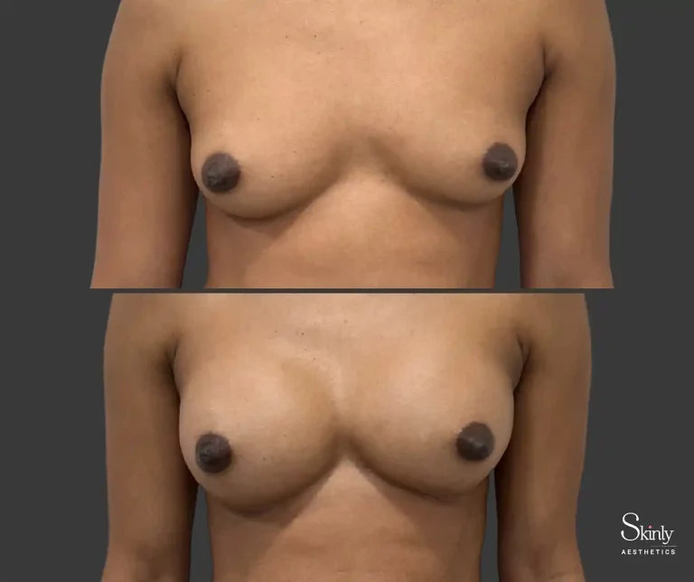Front breast filler results demonstrating volume restoration