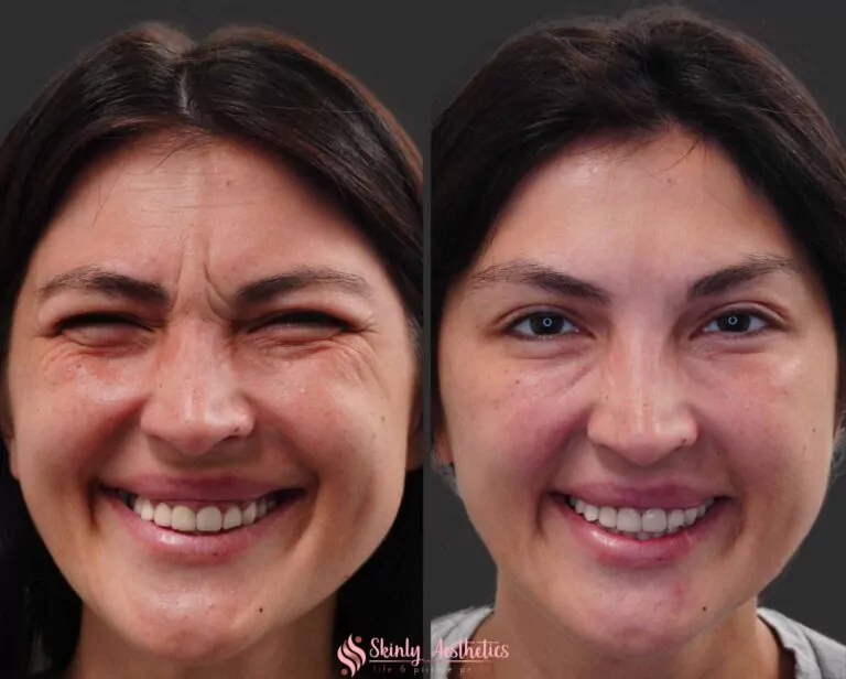 botox crows feet