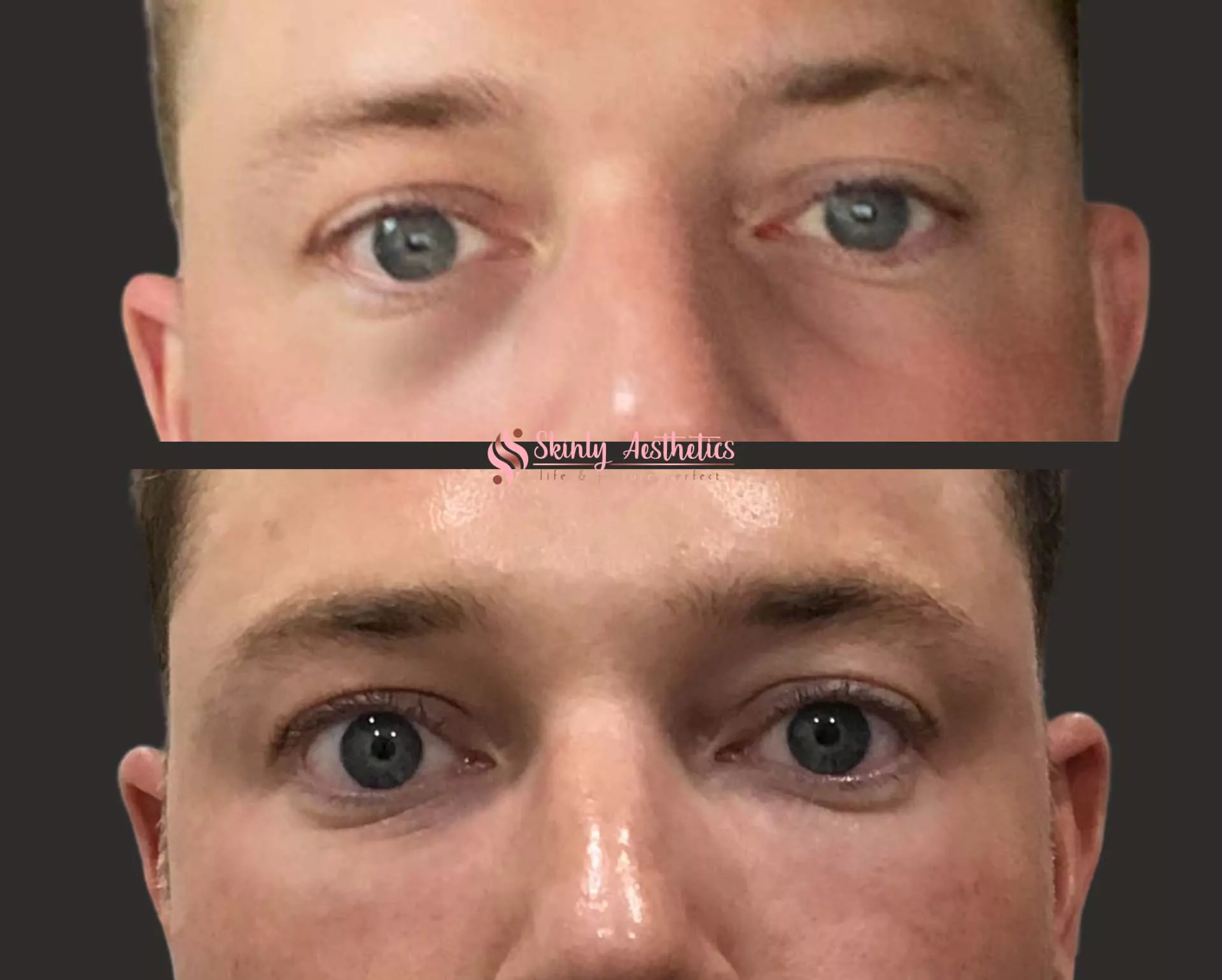 tear trough treatment with Juvederm Voluma