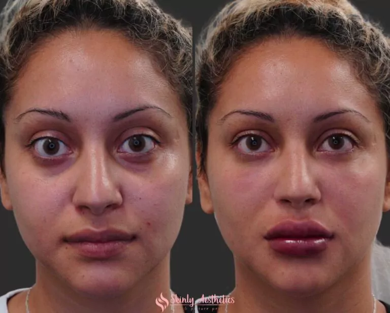under eye bag treatment with Juvederm filler