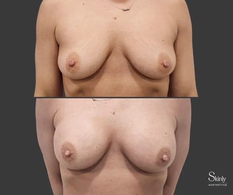 Liquid breast lift results showing lifted and fuller breasts