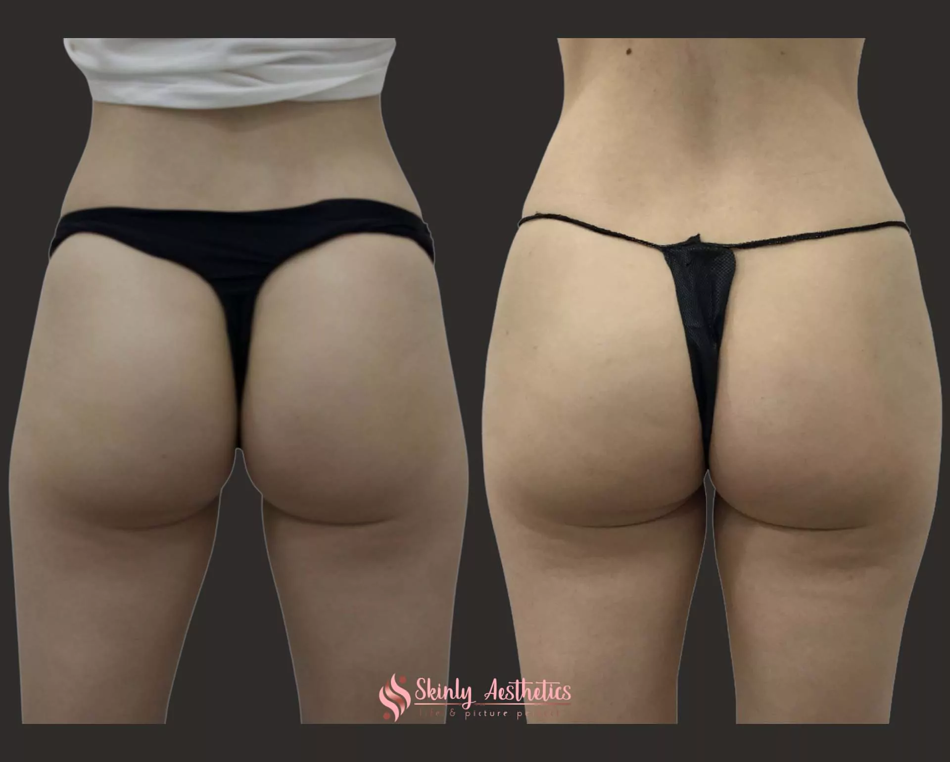 Sculptra filler hips results