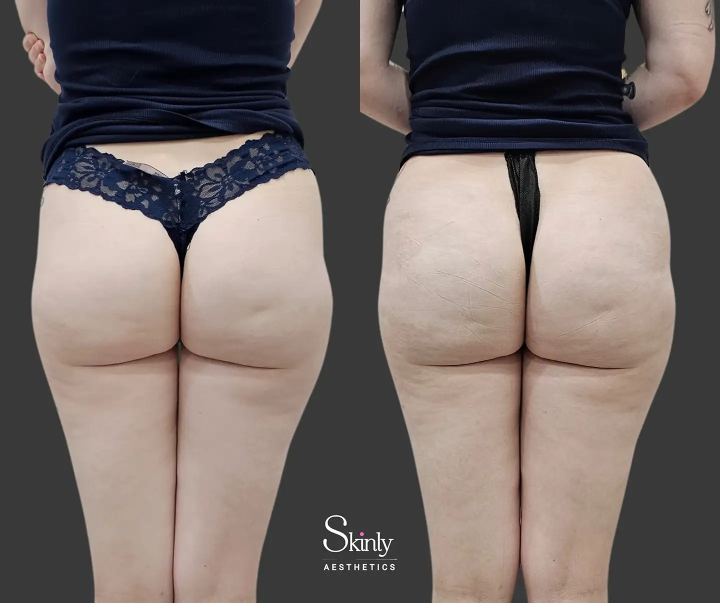 Dermal filler butt lift results from angled back view