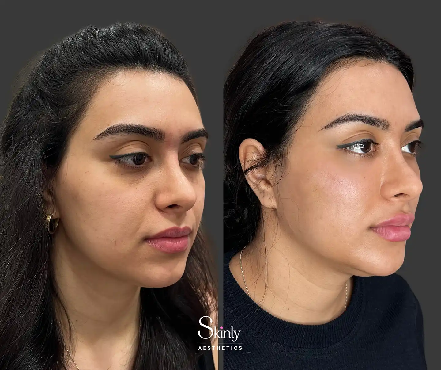 Side profile showing rejuvenated cheeks, defined jawline, and lifted brows after liquid facelift