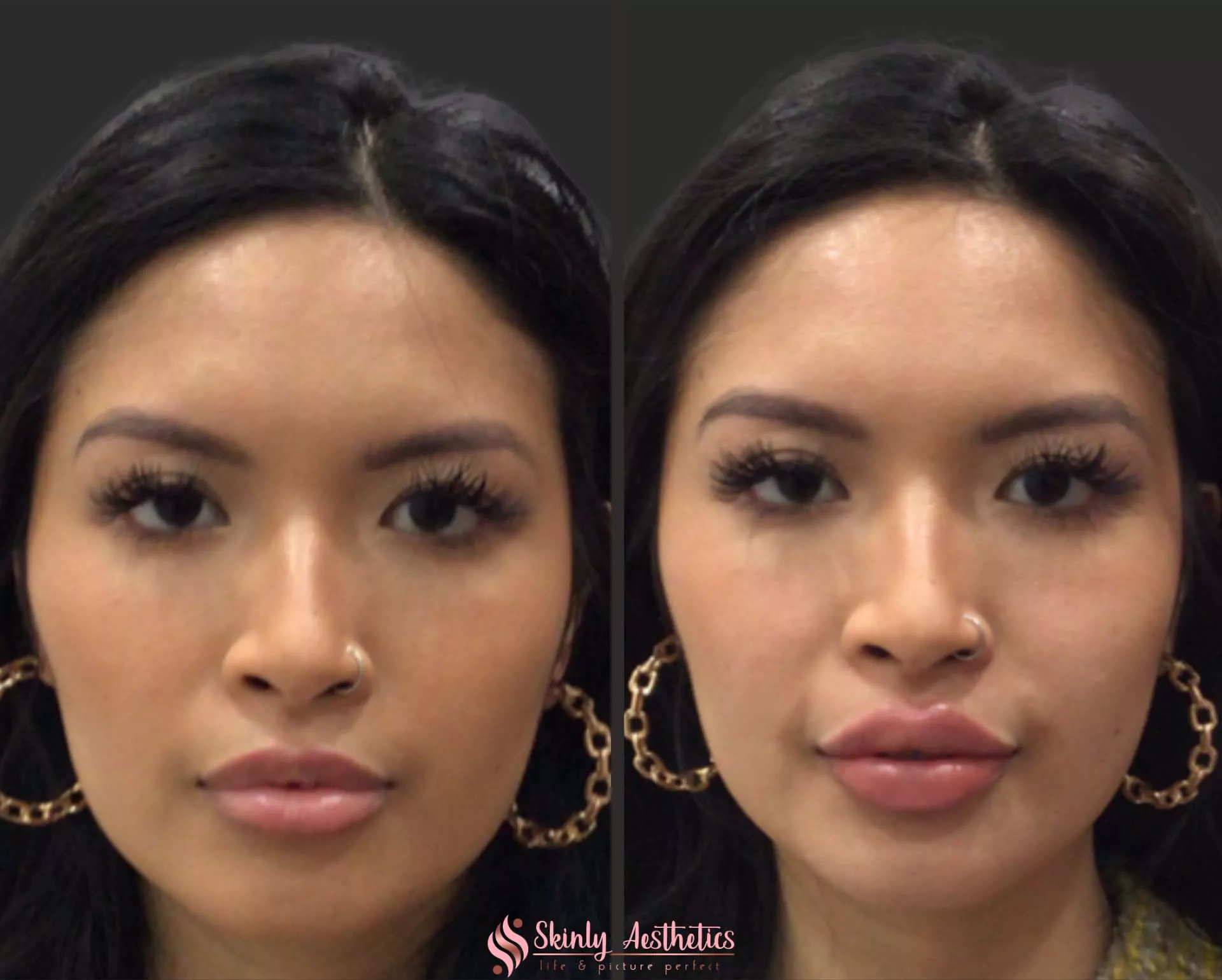 Russian technique lip augmentation