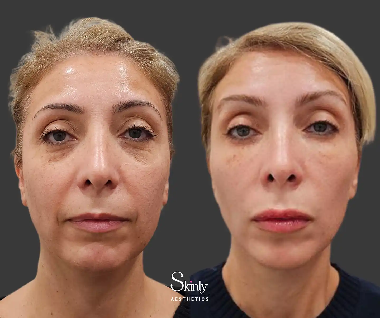 Front view demonstrating lifted eyebrows and rejuvenated midface after liquid facelift