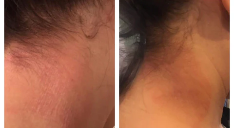 before and after results of moisturizer for stretch marks before and after results of moisturizer for stretch marks