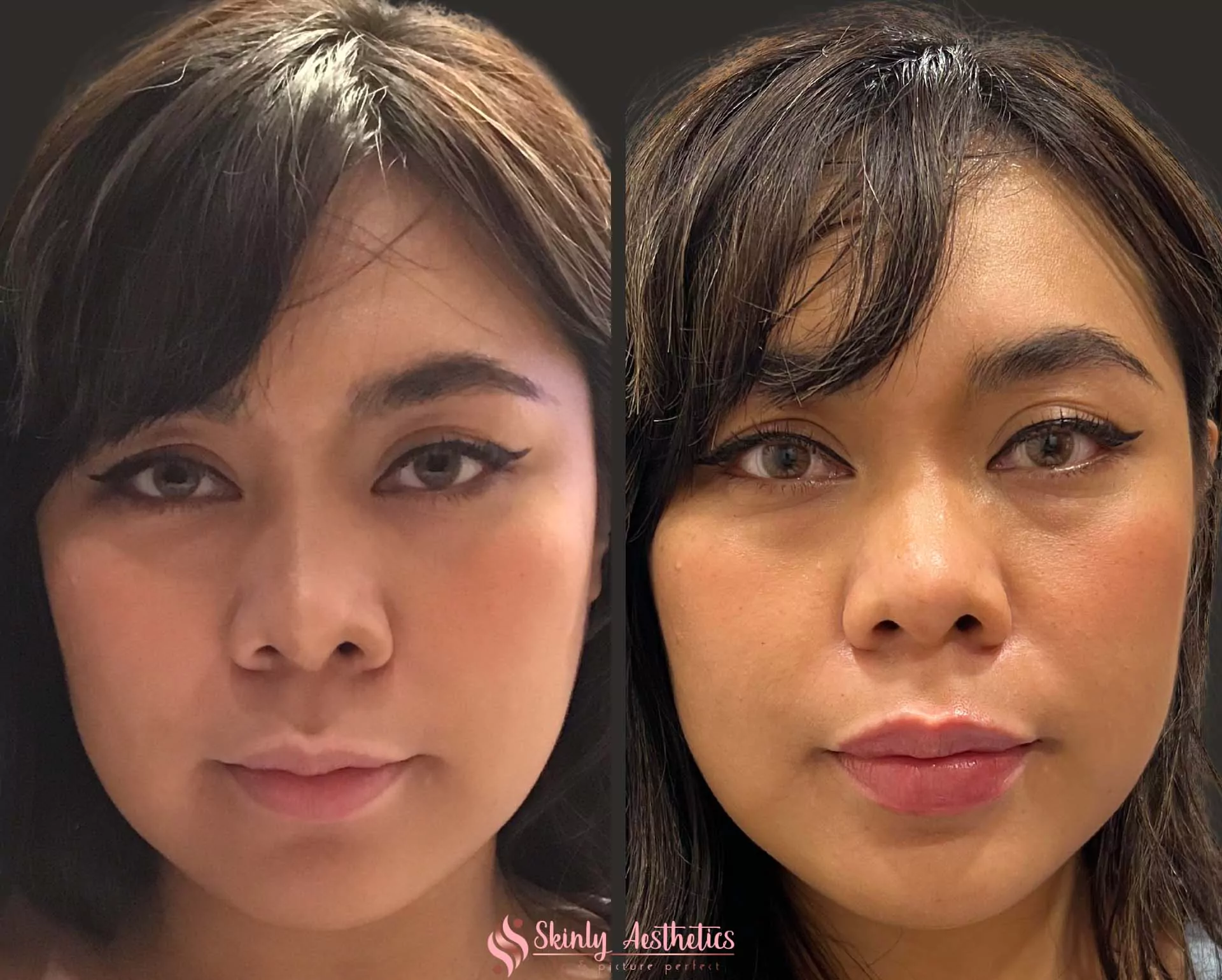 restylane lip filler augmentation 2