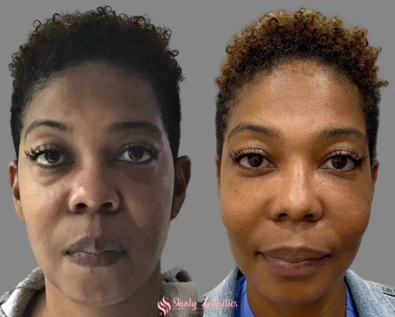 Juvederm Voluma treatment of under eye bags